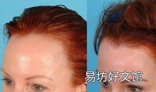 让发际线变低的小技巧 让发际线变低的小技巧有哪些