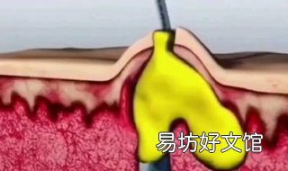 最有效祛痘方法 最有效祛痘方法有哪些