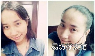 额头高头发少怎么办 额头头顶头发稀少怎么办