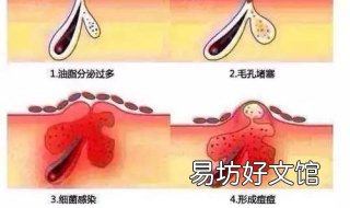 怎么有效治疗痤疮 怎么样治疗痤疮