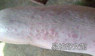 湿疹和皮炎的区别 湿疹跟皮炎有什么区别