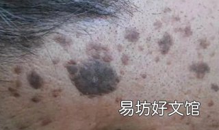 老年斑与黄褐斑的区别 老年斑与黄褐斑的区别是什么