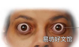 眼球突出怎么办 感觉眼球突出怎么办