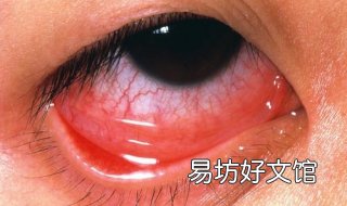眼球充血怎么办 外伤后眼球充血怎么办