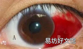 眼球出血怎么办 眼球出血怎么办快速止血