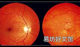 白眼球有黄斑怎么办 白眼球有黄斑怎么办图片