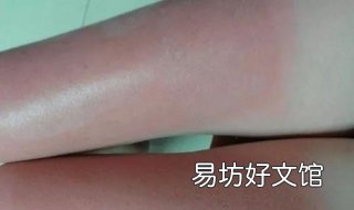 皮肤晒伤怎么办 皮肤晒伤怎么办快速恢复