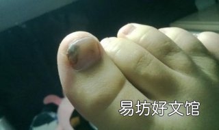 脚趾甲灰指甲怎么办 脚趾甲灰指甲怎么办亮甲见效快