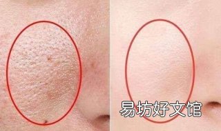 脸部毛孔粗大怎么办 脸部毛孔粗大怎么办怎么收缩毛孔有纹