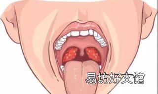 扁桃体炎怎么办 扁桃体发炎怎么办