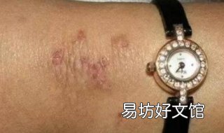 对金属过敏怎么办 皮肤对金属过敏怎么办