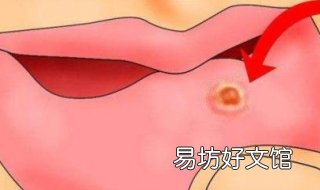 口舌生疮怎么办 心里有火口舌生疮怎么办