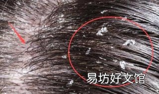 头屑多怎么办 秋冬头屑多怎么办