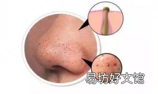 鼻子很多黑头怎么办 鼻子黑头怎么办鼻子黑头很重怎么办