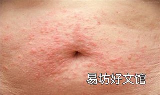 全身皮肤过敏怎么办 全身皮肤过敏怎么办止痒