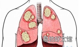 鳞癌和腺癌的区别 鳞癌和腺癌的区别哪个更常见