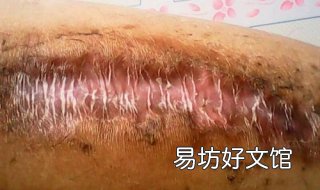 伤口化脓怎么办 烫伤后伤口化脓怎么办