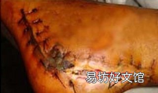 伤口不愈合怎么办 肛门伤口不愈合怎么办