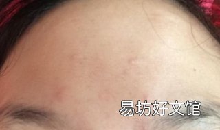 额头起痘痘怎么办 额头上起痘痘怎么治