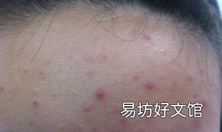 额头长痘怎么办 11岁小朋友额头长痘怎么办