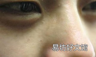 鼻子有黑头怎么办 16岁鼻子有黑头怎么办