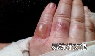 手被开水烫了怎么办 手被开水烫了怎么办什么时候能好
