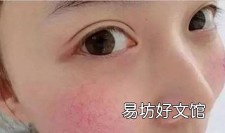 皮肤红血丝怎么办 皮肤过敏起红血丝怎么办