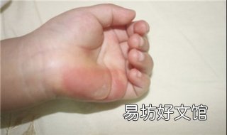 小孩烫伤起泡怎么办 儿童烫伤起泡怎么办