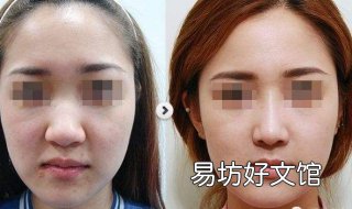 鼻翼太大怎么办 鼻孔因为长期抠鼻子鼻翼太大怎么办