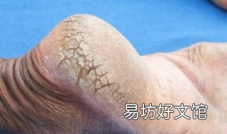 脚裂口子怎么办 脚裂口子怎么办?用什么药