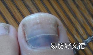脚指甲变厚怎么办 脚指甲怎么会变厚
