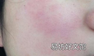 脸总过敏怎么办 脸经常过敏咋办