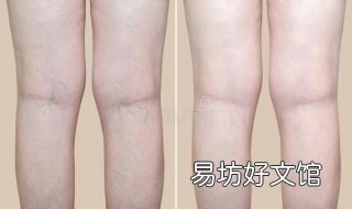 腿上有红血丝怎么办 腿上有红血丝怎么办小妙招