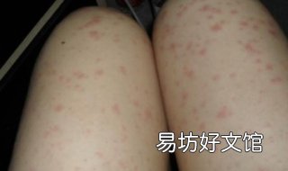 腿部皮肤过敏怎么办 腿部皮肤过敏了怎么办急救