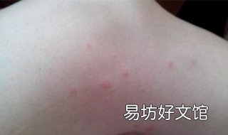 身上起红疙瘩很痒怎么办 全身起红疹很痒怎么办