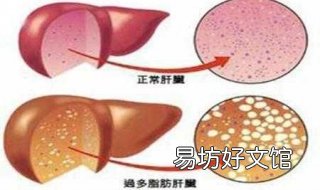轻度脂肪肝怎么办 得了轻度脂肪肝怎么办