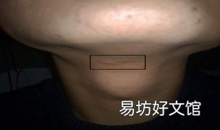 颈部淋巴结肿大怎么办 肺癌颈部淋巴结肿大怎么办