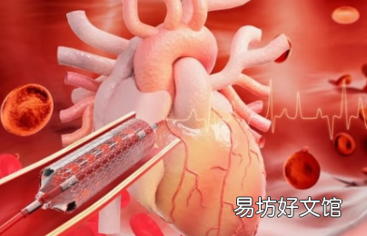 紫杉醇涂层球囊对冠状动脉支架内再狭窄有效