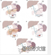 脾静脉高压的病因