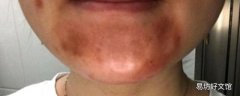刷酸祛痘效果怎么样 如何正确刷酸祛痘