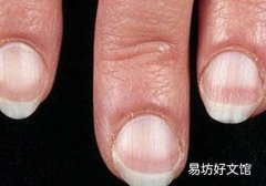 林赛氏指甲有依据吗,林赛氏指甲一定的是肾衰竭吗