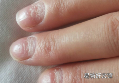 指甲有横纹严重吗 指甲上有横纹是怎么回事