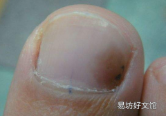大脚趾指甲凹凸不平怎么回事 大脚趾指甲凹凸不平怎么办
