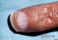 林赛氏指甲是真菌感染吗,林赛氏指甲和真菌感染指甲的区别