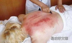 月经推迟可以刮痧吗 月经推迟刮痧治疗