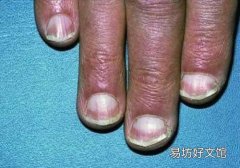 怎么确定是不是林赛氏指甲 三个方面教你确定林赛氏指甲