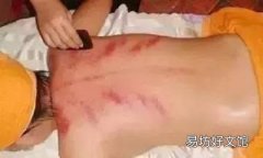 长痤疮刮痧什么部位 痤疮刮痧方法