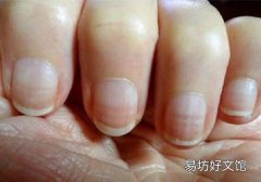 林赛氏指甲怎么进补 林赛氏指甲喝什么汤