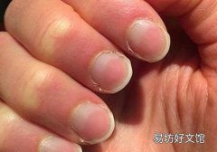 林赛氏指甲吃什么维生素 需要补的多了去了