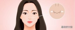 隆鼻挛缩是什么造成的 隆鼻两个月稳定了吗